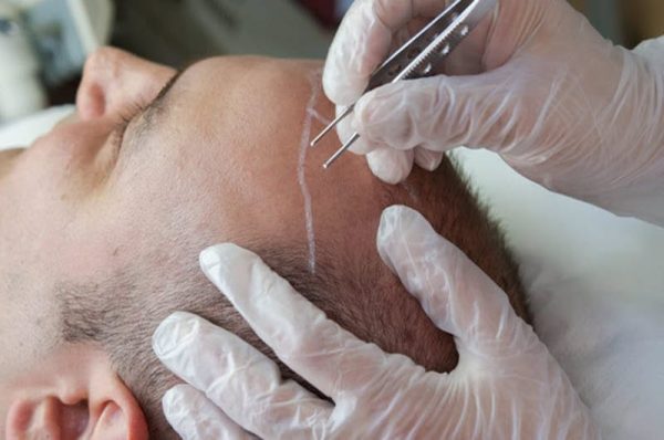strengthen-and-transplant-hair بهترین مرکز کاشت مو در غرب تهران | کلینیک اورانوس