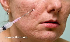 سابسیژن - کلینیک اورانوس