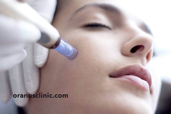 میکرونیدلینگ - کلینیک اورانوس