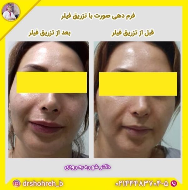 کلینیک فرم دهی صورت با تزریق فیلر | اورانوس