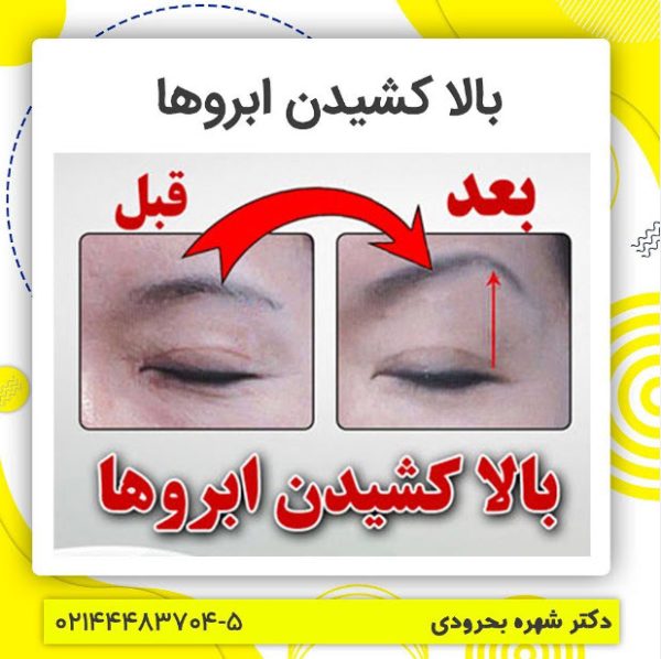 بالا کشیدن ابروها در کلینیک زیبایی اورانوس
