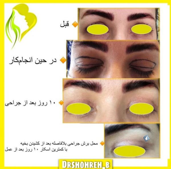 کلینیک رفع خطوط صورت در غرب تهران | کلینیک اورانوس