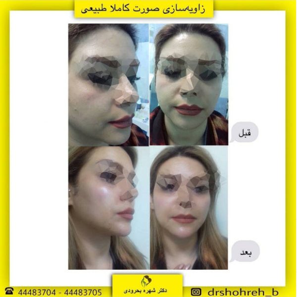 زاویه سازی صورت در غرب تهران | کلینیک اورانوس