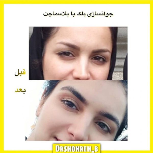 جوانسازی پلک با پلاسما جت در غرب تهران | کلینیک اورانوس