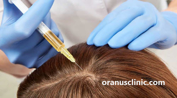 انجام هیر فیلر در غرب تهران - کلینیک اورانوس