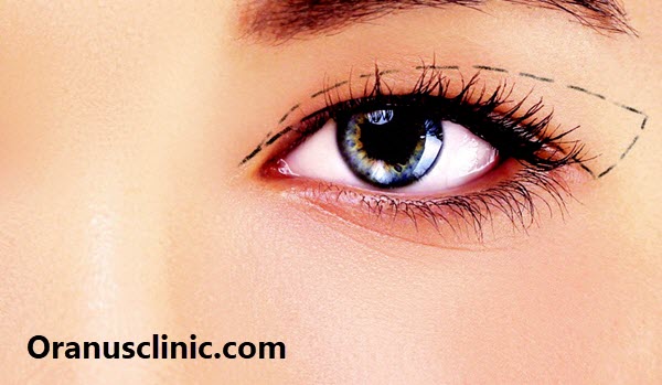 بهترین جراح بلفارو در کلینیک اورانوس - کلینیک اورانوس