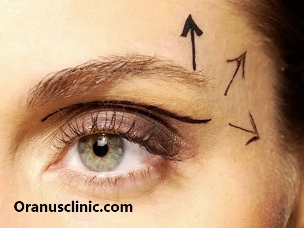 بهترین جراح بلفارو در کلینیک اورانوس - کلینیک اورانوس