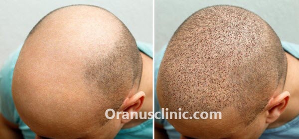 بهترین کلینیک کاشت مو در غرب تهران - کلینیک اورانوس