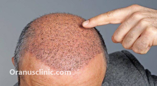 بهترین کلینیک کاشت مو در غرب تهران - کلینیک اورانوس