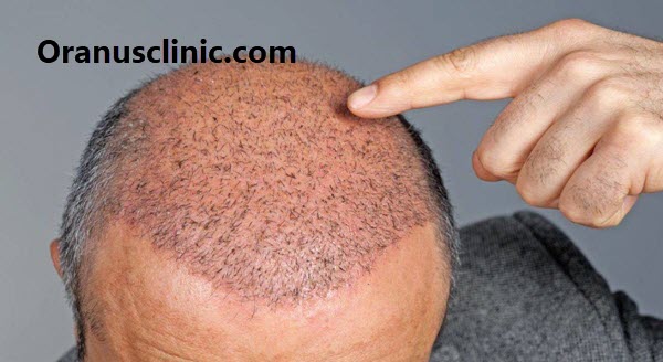 کاشت مو در تهران با قیمت مناسب - کلینیک اورانوس