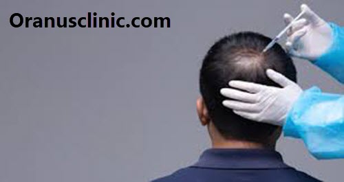 کاشت مو در تهران با قیمت مناسب - کلینیک اورانوس