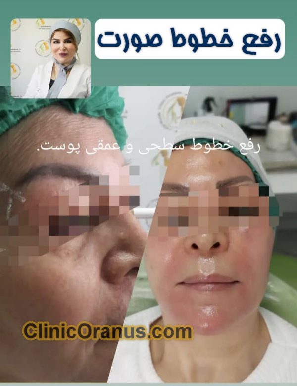 رفع خطوط صورت در غرب تهران | کلینیک اورانوس