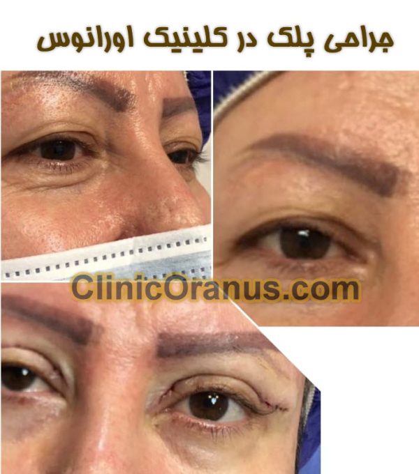 جراحی پلک در کلینیک اورانوس
