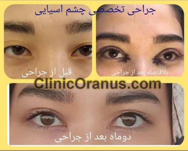 جراحی چشم آسیایی در رب تهران | کلینیک اورانوس