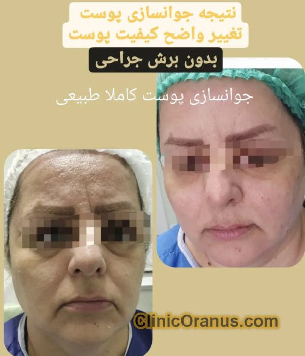 جوانسازی پوست در غرب تهران | کلینیک اورانوس