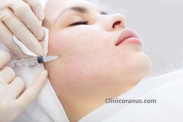 مراقبت های بعد از مزوتراپی پوست صورت - کلینیک اورانوس