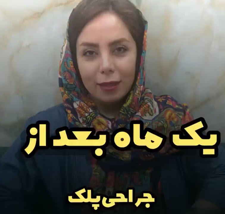 یک-ماه-بعد-از-عمل-بلفارو رضایت زیباجویان بلفاروپلاستی از کلینیک اورانوس