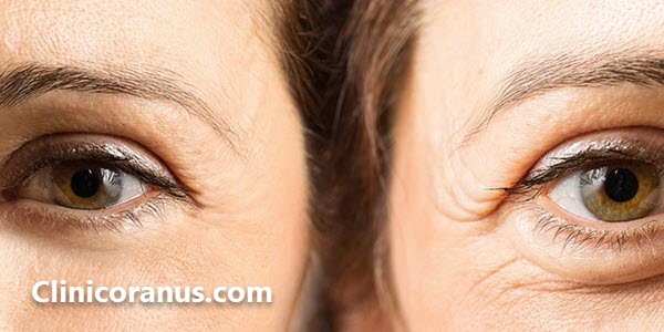 بهترین مرکز بلفارو در تهران کجاست؟ - کلینیک اورانوس