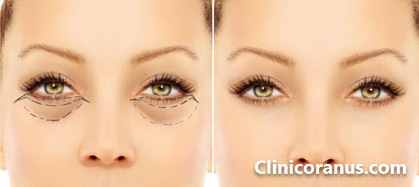 بهترین مرکز بلفارو در تهران کجاست؟ - کلینیک اورانوس