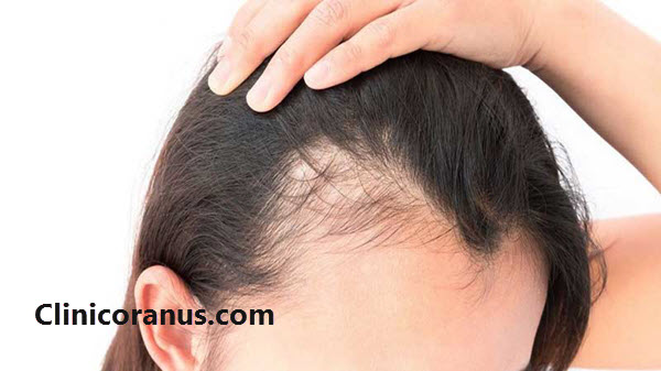 راهکارهای درمان ریزش مو که باید بدانید - کلینیک اورانوس