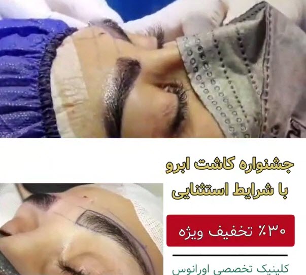 تخفیف-کاشت-ابرو-در-غرب-تهران-کلینیک-اورانوس-clinicoranus.com تخفیف کاشت ابرو در غرب تهران | کلینیک اورانوس