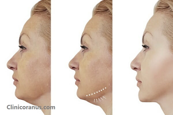 هایفو صورت و غبغب به چه نحوی است؟ | کلینیک اورانوس