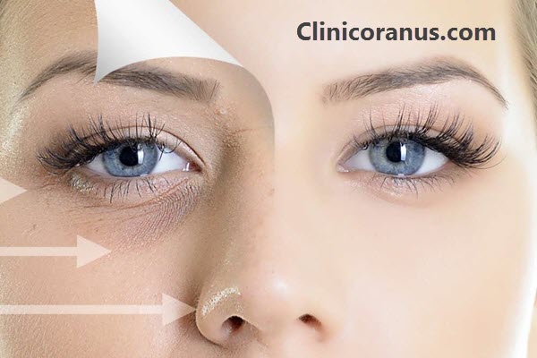 تاثیر فیلر زیر چشم برای رفع گودی و سیاهی - کلینیک اورانوس
