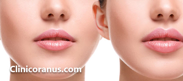قیمت تزریق ژل لب - کلینیک اورانوس