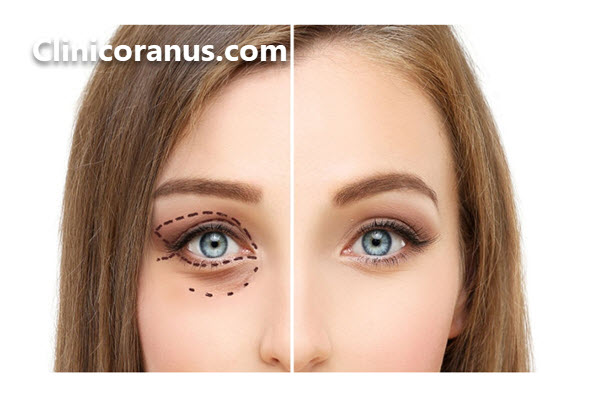 بلفاروپلاستی پلک بالا در تهران - کلینیک اورانوس