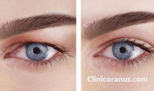 بهترین دکتر عمل پلک در تهران - کلینیک اورانوس