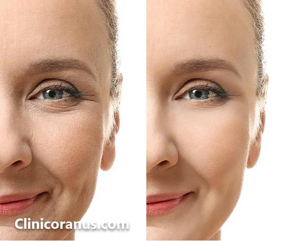 دکتر تزریق چربی در غرب تهران - کلینیک اورانوس