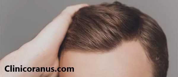 دکتر کاشت موی خوب در جنت آباد - کلینیک اورانوس