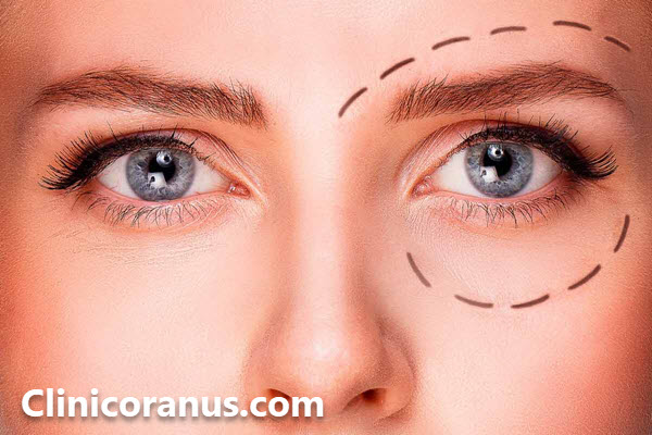 هزینه درمان افتادگی پلک - کلینیک اورانوس