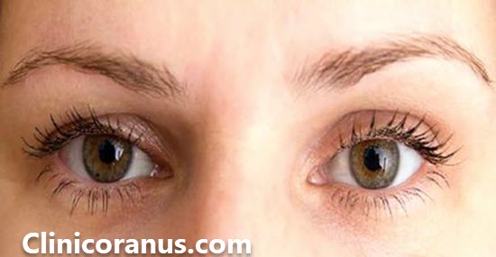 کلینیک همواره تخفیف جراحی پلک در غرب تهران | کلینیک اورانوس