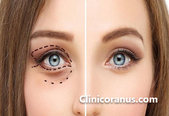 کلینیک همواره تخفیف جراحی پلک در غرب تهران | کلینیک اورانوس