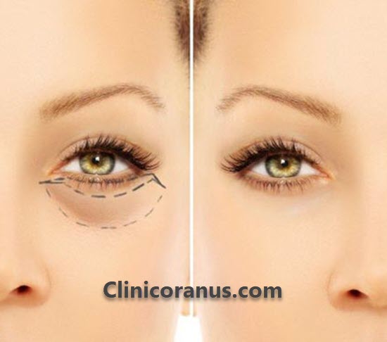 کلینیک زیبایی مجوز دار برای جراحی پلک | کلینیک اورانوس