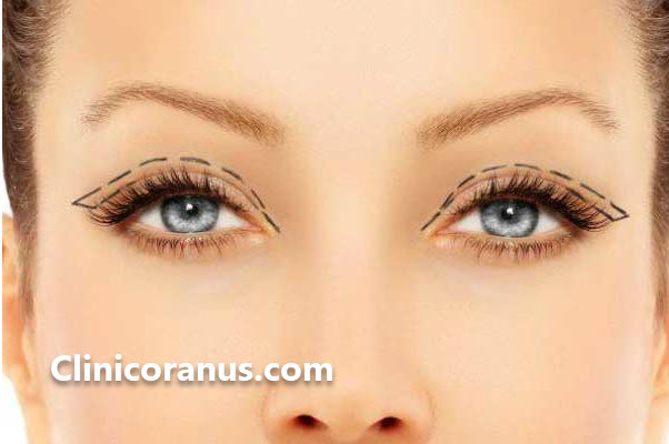 کلینیک همواره تخفیف جراحی پلک در غرب تهران | کلینیک اورانوس