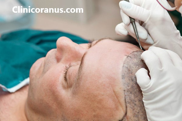 کلینیک کاشت موی طبیعی در غرب تهران - کلینیک اورانوس