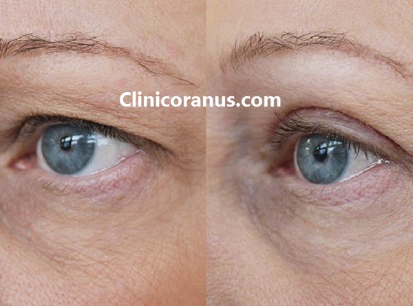 جراحی پلک در غرب تهران - کلینیک اورانوس