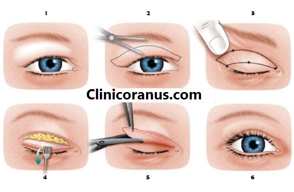 جراحی پلک در غرب تهران - کلینیک اورانوس