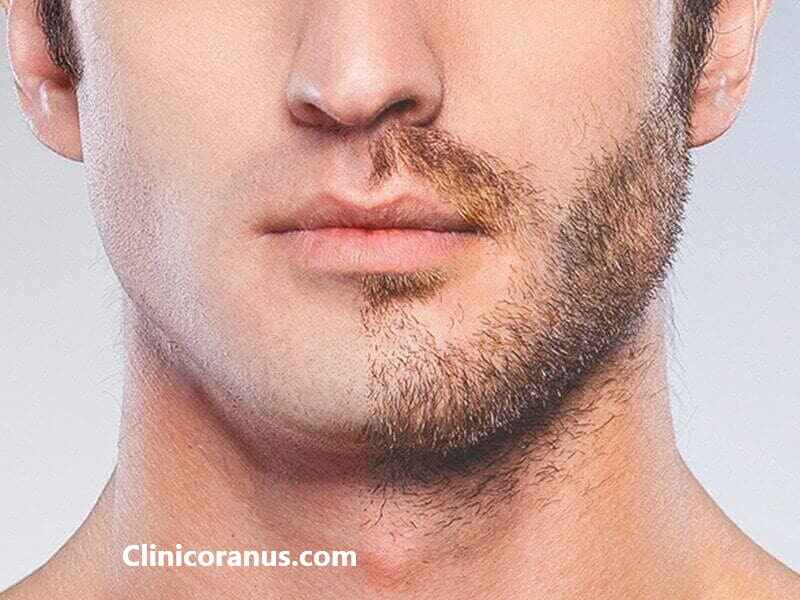 کاشت ریش و سبیل در جنت آباد - کلینیک اورانوس