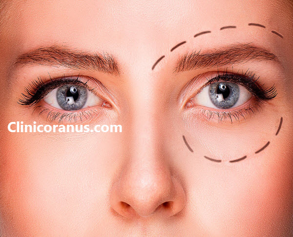 جراحی پلک در غرب تهران - کلینیک اورانوس