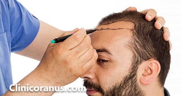 بهترین دکتر کاشت مو در جنت آباد - کلینیک اورانوس
