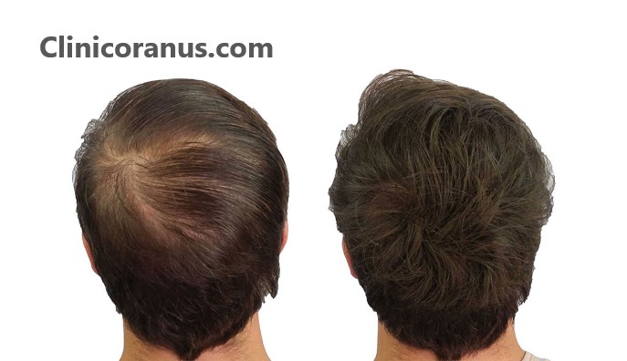 بهترین دکتر کاشت مو در غرب تهران - کلینیک اورانوس