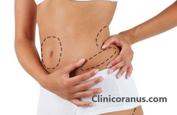 بهترین کلینیک برای جراحی لاغری در تهران - کلینیک اورانوس