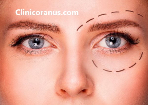 برای بلفاروپلاستی در غرب تهران کجا بریم؟ - کلینیک اورانوس