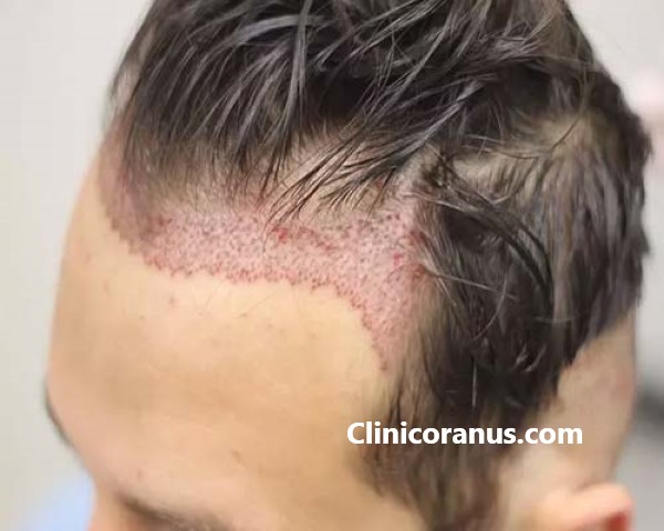 بهترین مرکز کاشت مو در غرب تهران | کلینیک اورانوس