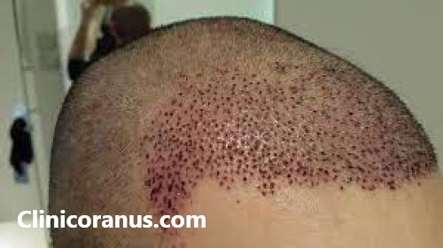 بهترین کلینیک تخصصی کاشت مو در غرب تهران | کلینیک اورانوس