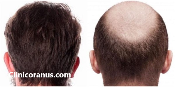 بهترین کلینیک تخصصی کاشت مو در غرب تهران | کلینیک اورانوس