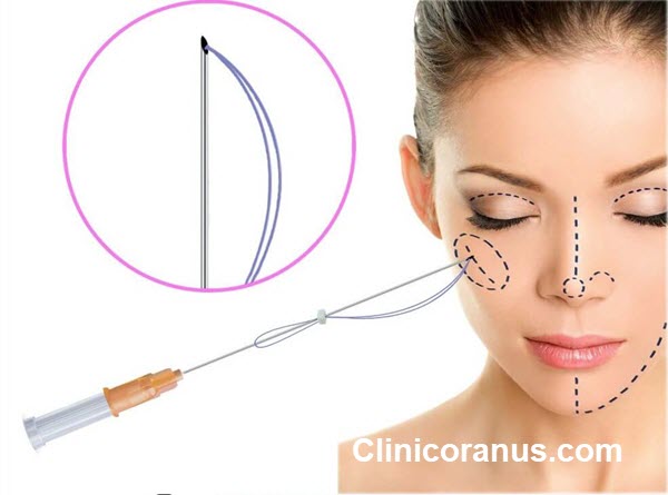 بهترین کلینیک لیفت صورت با نخ در جنت آباد - کلینیک اورانوس